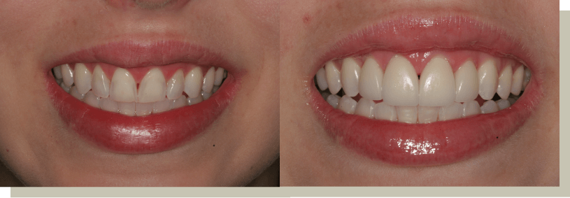 Direct Bonding Front Teeth