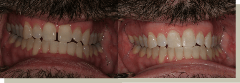 Closing front tooth gap with bonding