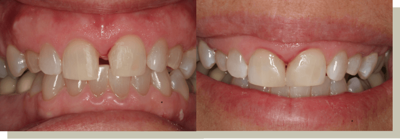 Gap closure with bonding