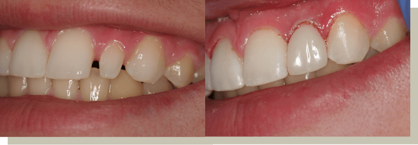 Direct bonding on lateral tooth