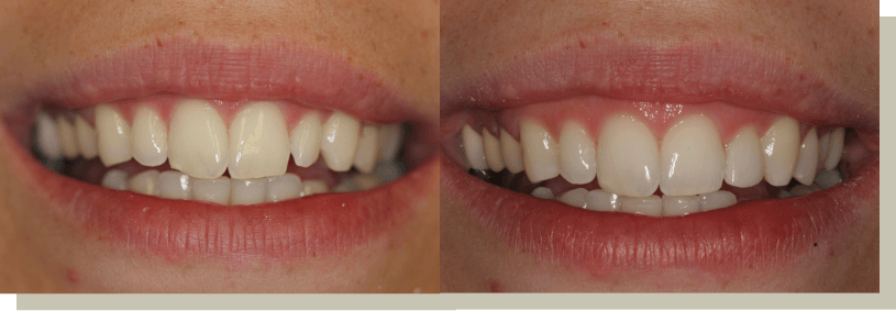 Direct bonding on front teeth