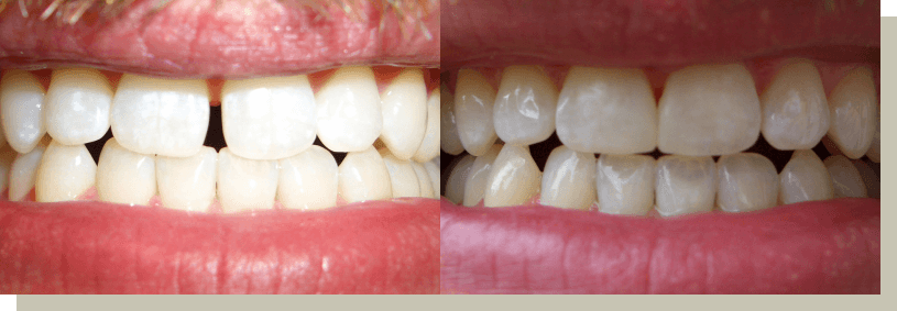 Closing gaps with bonding